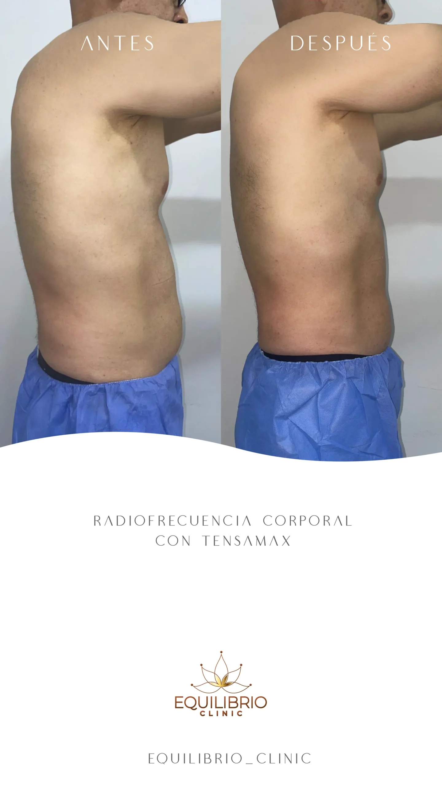 Resultado de moldeamiento corporal 2