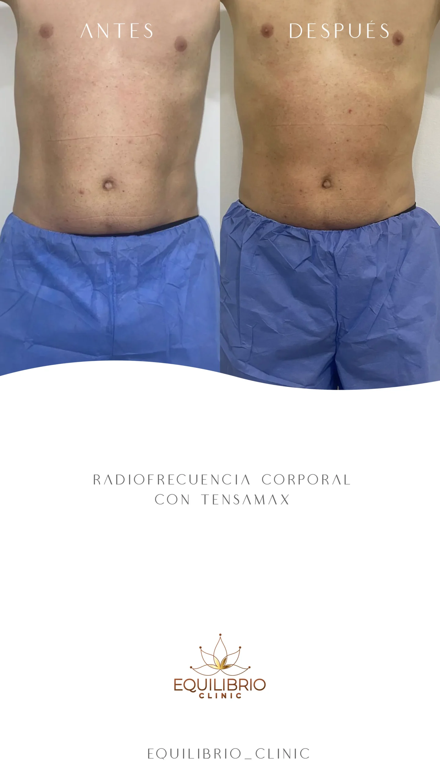 Resultado de moldeamiento corporal 3