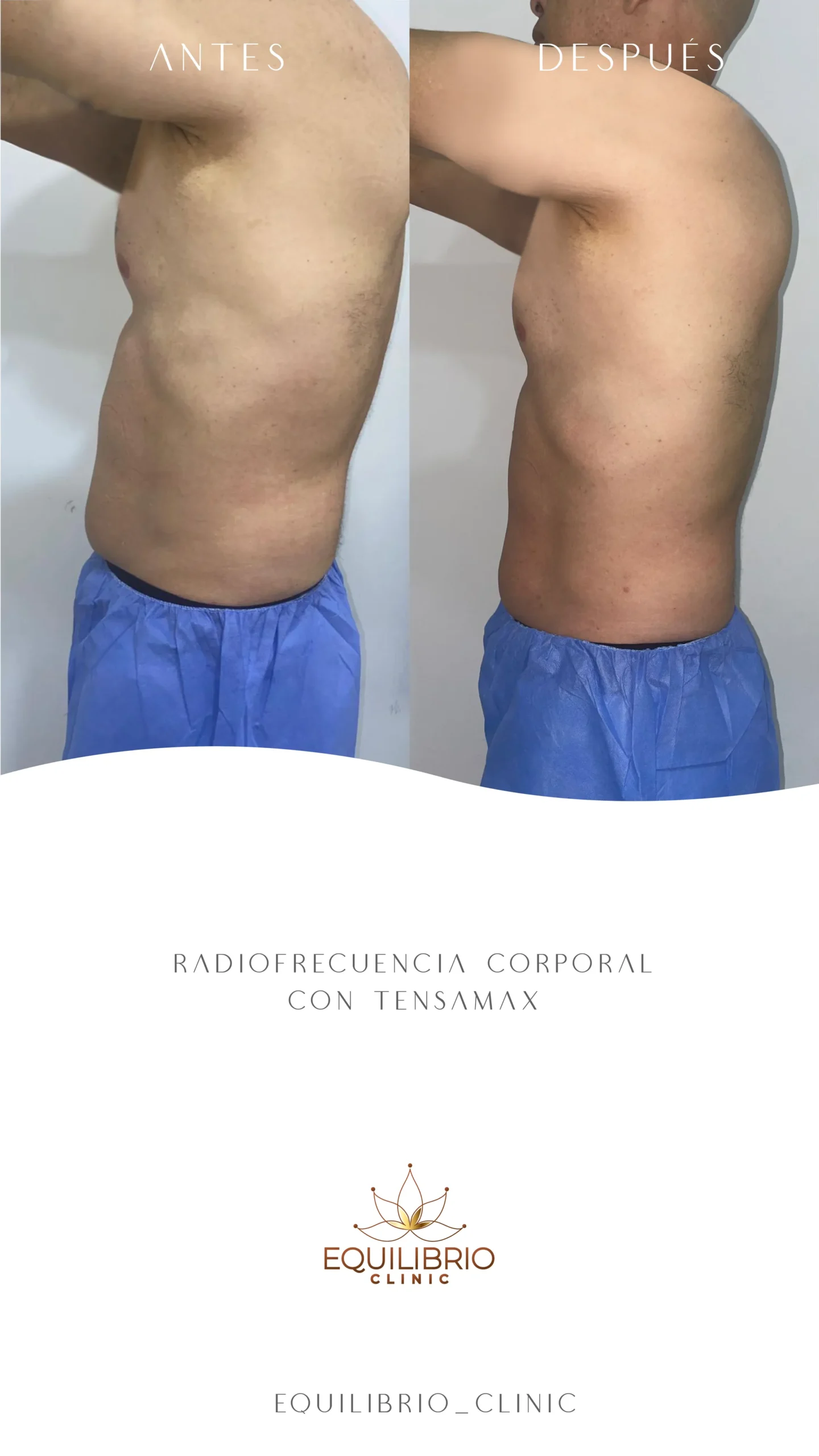 Resultado de moldeamiento corporal 3