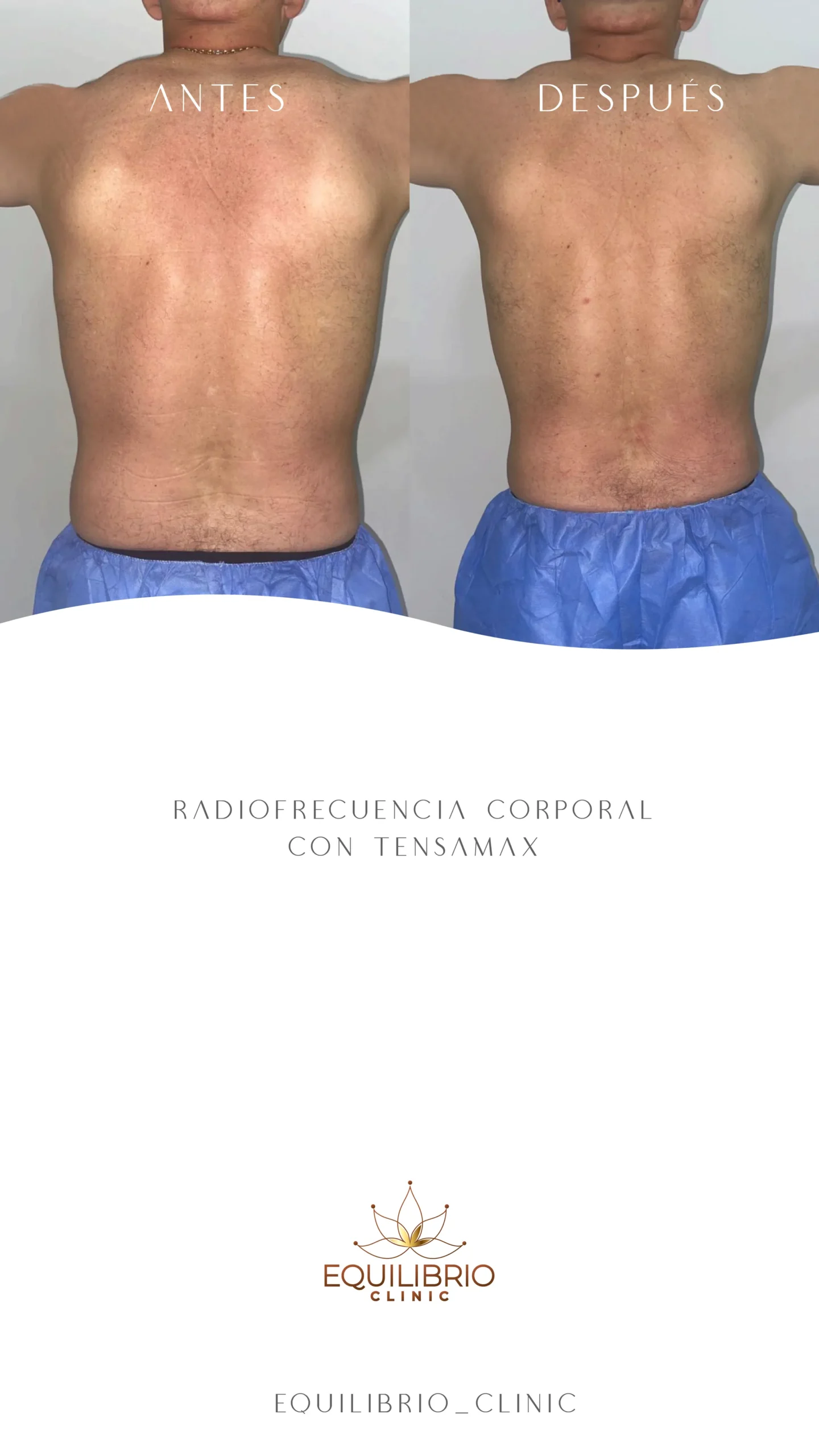 Resultado de moldeamiento corporal 1