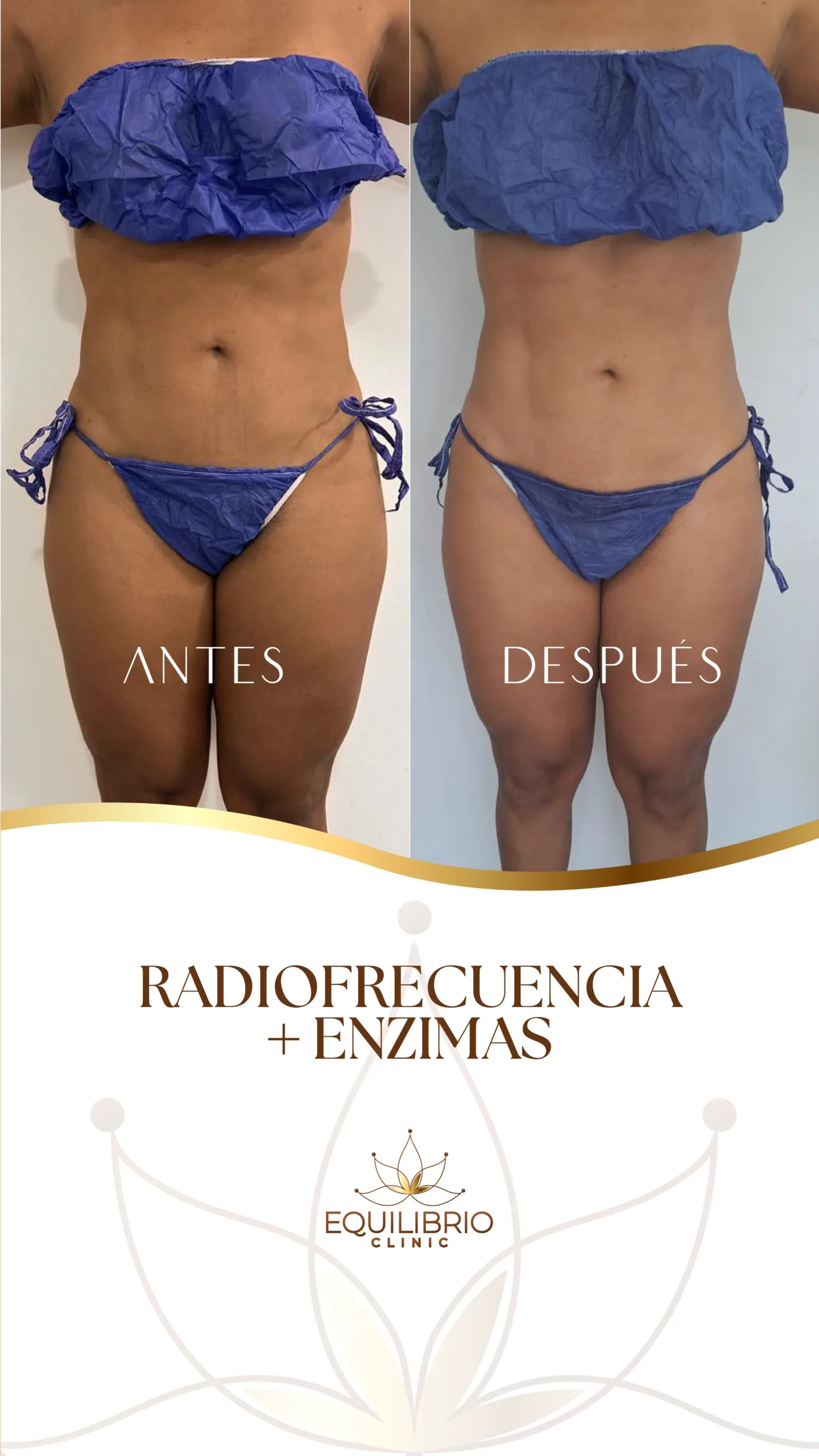 Resultado de moldeamiento corporal 1