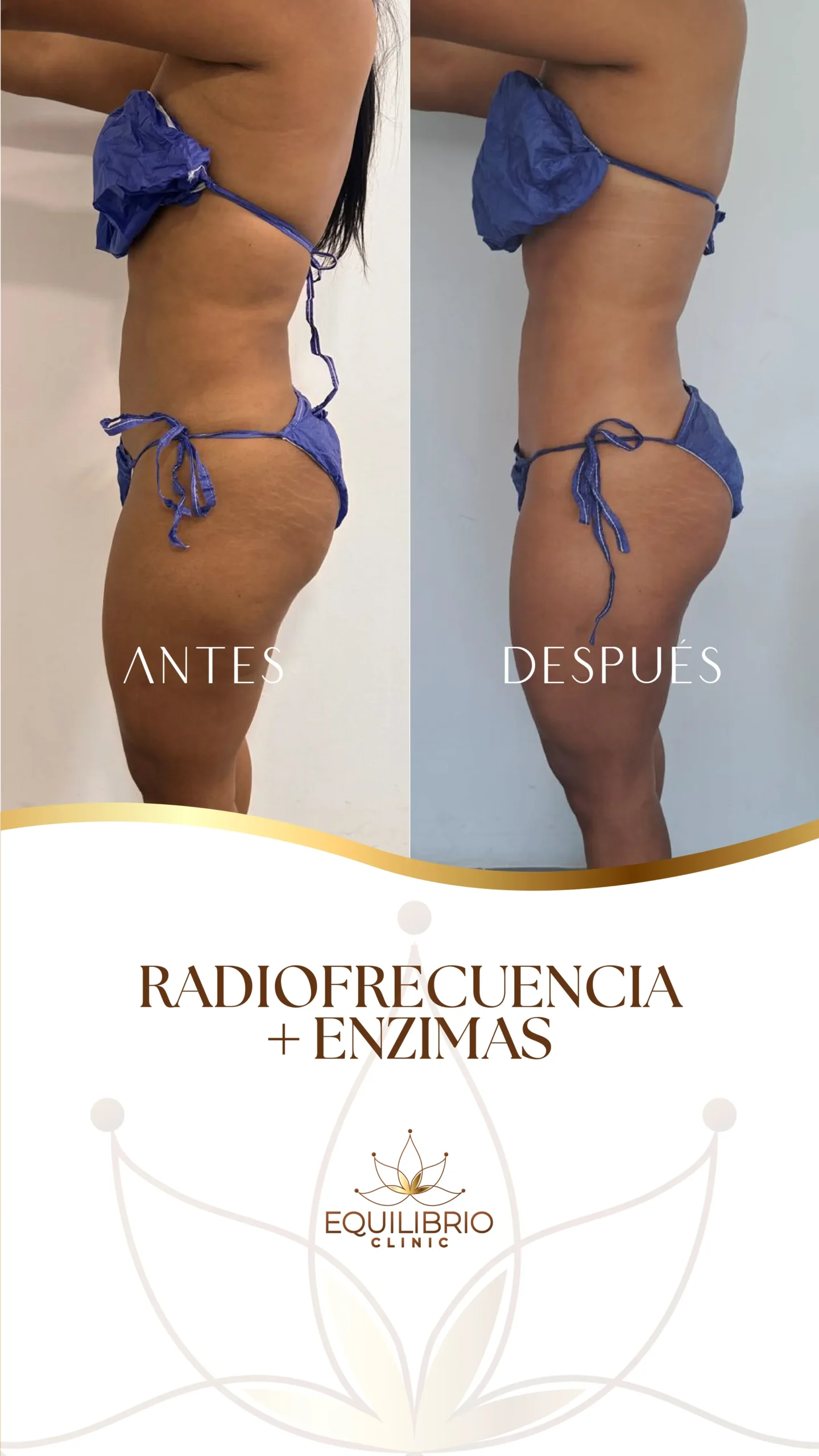 Resultado de moldeamiento corporal 2